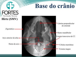 Base do crânio
Hirtz (SMV)
Lâmina perpendicular
do etmóide
Ramo mandibular
Forame transverso de C2
Células mastódeas
Forame magno
Zigomático
Arco anterior de atlas
Dente do axis
 