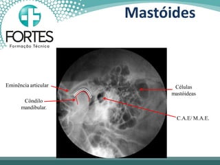 Mastóides
Células
mastóideas
C.A.E/ M.A.E.
Côndilo
mandibular.
Eminência articular
 