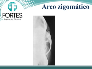 Arco zigomático
 