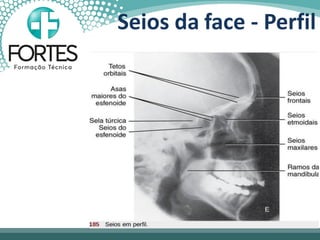Seios da face - Perfil
 