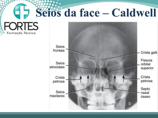 Seios da face – Caldwell
 