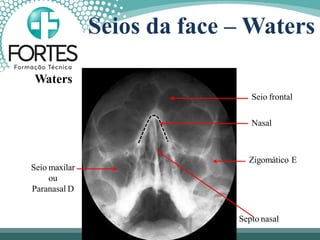 Seios da face – Waters
Seio frontal
Nasal
Zigomático E
Septo nasal
Seio maxilar
ou
Paranasal D
Waters
 