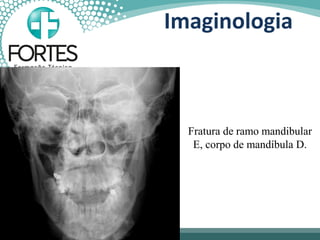 Fratura de ramo mandibular
E, corpo de mandíbula D.
Imaginologia
 