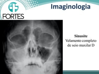 Sinusite
Velamento completo
de seio maxilar D
Imaginologia
 