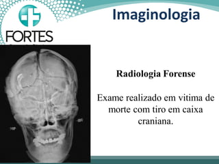 Radiologia Forense
Exame realizado em vitima de
morte com tiro em caixa
craniana.
Imaginologia
 