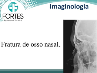 Fratura de osso nasal.
Imaginologia
 