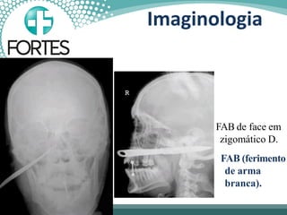 FAB de face em
zigomático D.
FAB (ferimento
de arma
branca).
Imaginologia
 