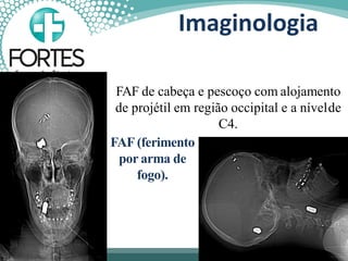 FAF de cabeça e pescoço com alojamento
de projétil em região occipital e a nívelde
C4.
FAF (ferimento
por arma de
fogo).
Imaginologia
 
