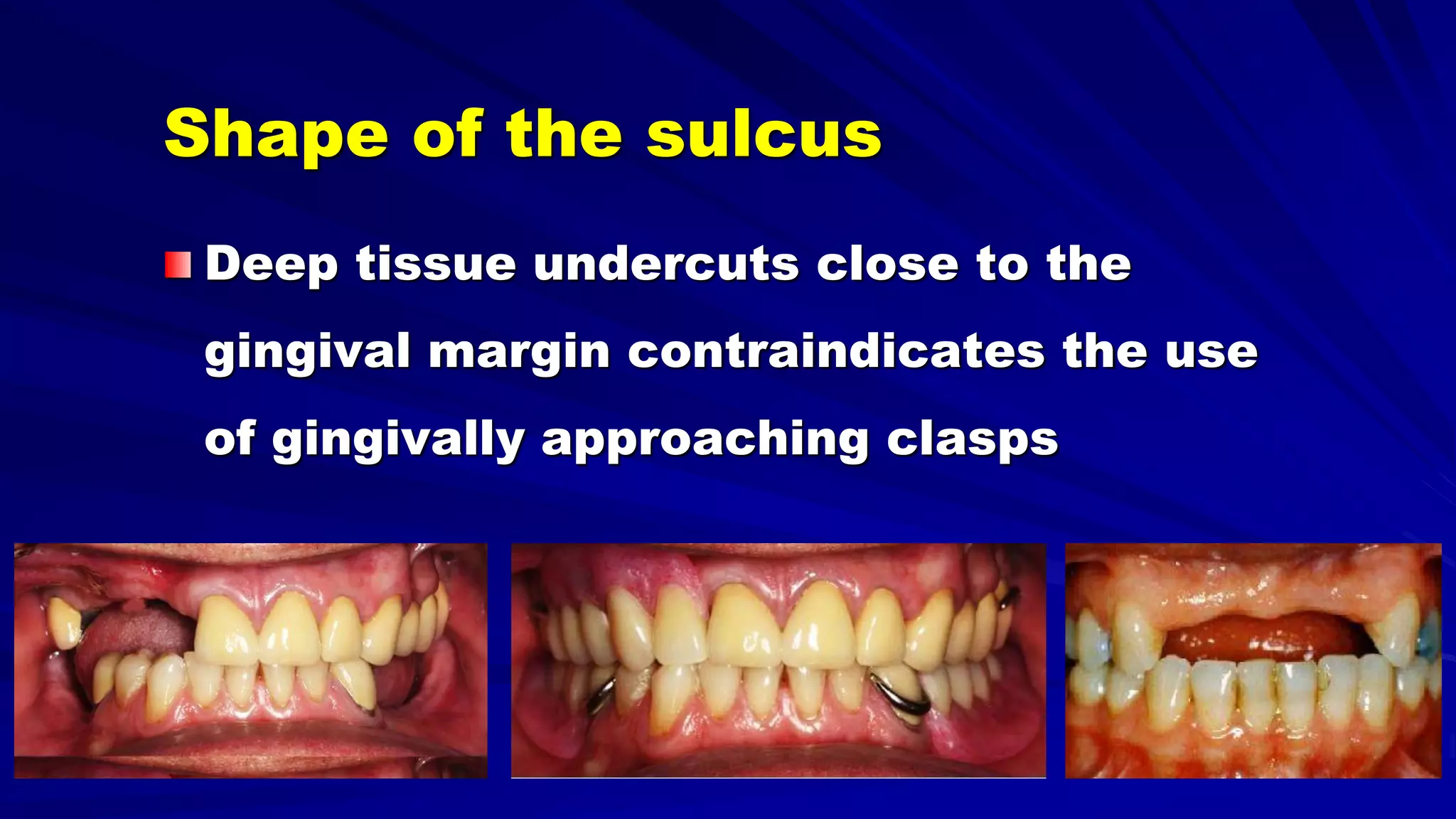5- Basic principles for designing the removable partial denture class i ...