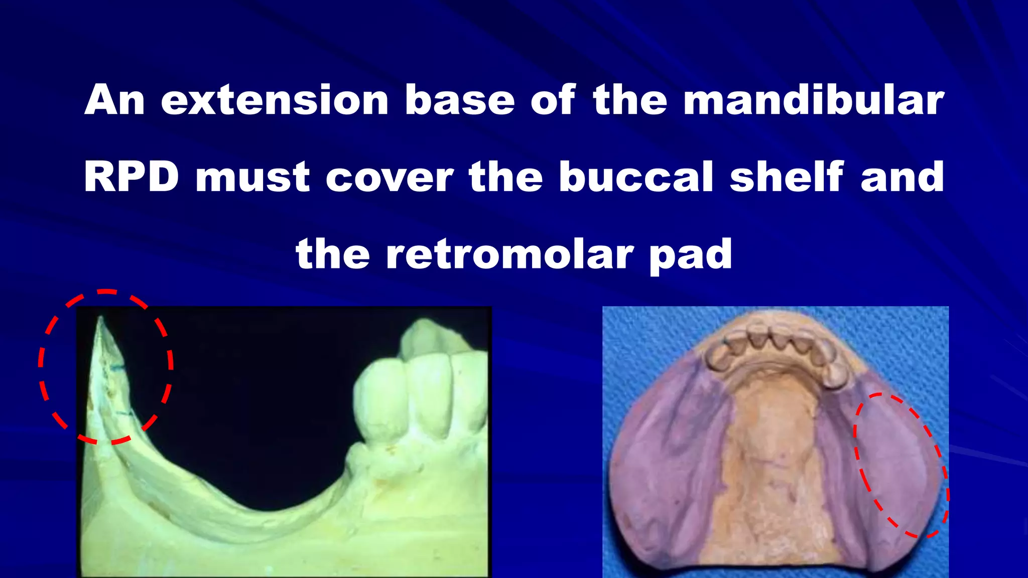 Mand Rpd 5- Basic principles for designing the removable partial denture class i ...