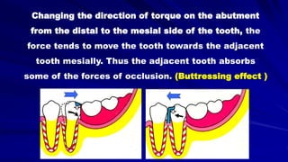 Changing the direction of torque on the abutment
from the distal to the mesial side of the tooth, the
force tends to move the tooth towards the adjacent
tooth mesially. Thus the adjacent tooth absorbs
some of the forces of occlusion. (Buttressing effect )
 