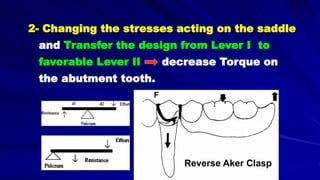 Reverse Aker Clasp
F
2- Changing the stresses acting on the saddle
and Transfer the design from Lever I to
favorable Lever II decrease Torque on
the abutment tooth.
 