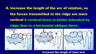 4. Increase the length of the arc of rotation, so
the forces transmitted to the ridge are more
vertical A vertical force in better tolerated by
ridge than is a horizontal oblique force
Increase the length of lever arm
 