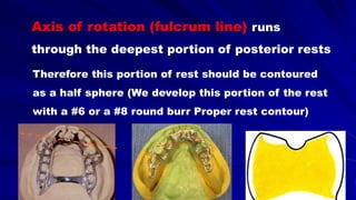 Axis of rotation (fulcrum line) runs
through the deepest portion of posterior rests
Therefore this portion of rest should be contoured
as a half sphere (We develop this portion of the rest
with a #6 or a #8 round burr Proper rest contour)
 