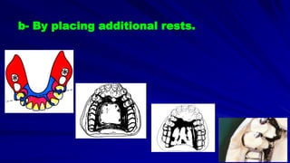 b- By placing additional rests.
 