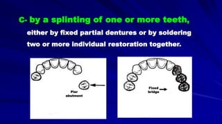 C- by a splinting of one or more teeth,
either by fixed partial dentures or by soldering
two or more individual restoration together.
Fixed
bridgePier
abutment
 