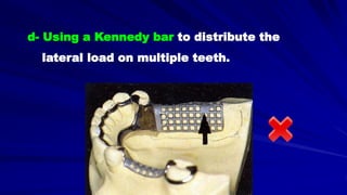 d- Using a Kennedy bar to distribute the
lateral load on multiple teeth.
 
