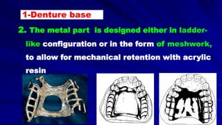 2. The metal part is designed either in ladder-
like configuration or in the form of meshwork,
to allow for mechanical retention with acrylic
resin
1-Denture base
 
