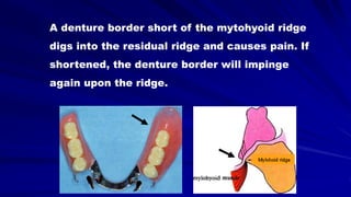 A denture border short of the mytohyoid ridge
digs into the residual ridge and causes pain. If
shortened, the denture border will impinge
again upon the ridge.
 