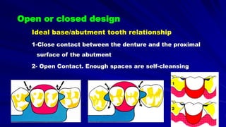 Open or closed design
Ideal base/abutment tooth relationship
1-Close contact between the denture and the proximal
surface of the abutment
2- Open Contact. Enough spaces are self-cleansing
 