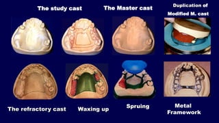 The refractory cast
The study cast The Master cast
Modified M. cast
Duplication of
Waxing up
Spruing Metal
Framework
 