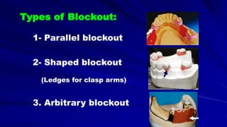 1- Parallel blockout
2- Shaped blockout
(Ledges for clasp arms)
3. Arbitrary blockout
Types of Blockout:
 