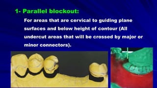 For areas that are cervical to guiding plane
surfaces and below height of contour (All
undercut areas that will be crossed by major or
minor connectors).
1- Parallel blockout:
 