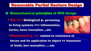 * Mechanical p. >>> related to resistance of
forces and its application to object >> looseness
of teeth, bon resorption……etc
Biomechanical principles of RPD design
* Bio >>> biological p. pertaining
to living systems >>> inflammation,
Caries, bone resorption….etc
Removable Partial Denture Design
 