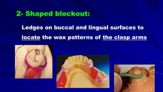 2- Shaped blockout:
Ledges on buccal and lingual surfaces to
locate the wax patterns of the clasp arms
 