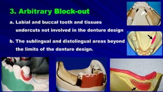 a. Labial and buccal tooth and tissues
undercuts not involved in the denture design
b. The sublingual and distolingual areas beyond
the limits of the denture design.
3. Arbitrary Block-out
 