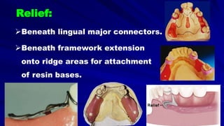 Beneath lingual major connectors.
Beneath framework extension
onto ridge areas for attachment
of resin bases.
Relief:
 