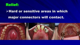 Hard or sensitive areas in which
major connectors will contact.
Relief:
 