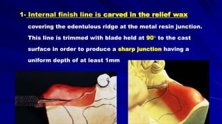 1- Internal finish line is carved in the relief wax
covering the edentulous ridge at the metal resin junction.
This line is trimmed with blade held at 90° to the cast
surface in order to produce a sharp junction having a
uniform depth of at least 1mm
 