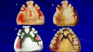 3
2
4
1
Internal finish line
 