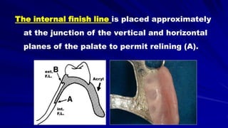 The internal finish line is placed approximately
at the junction of the vertical and horizontal
planes of the palate to permit relining (A).
int.
F.L.
ext.
F.L.
Acryl
 