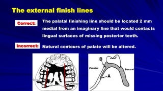 The palatal finishing line should be located 2 mm
medial from an imaginary line that would contacts
lingual surfaces of missing posterior teeth.
Natural contours of palate will be altered.
Palatal
Buccal
Correct:
Incorrect:
The external finish lines
 