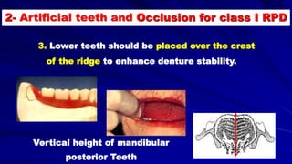 3. Lower teeth should be placed over the crest
of the ridge to enhance denture stability.
Vertical height of mandibular
posterior Teeth
2- Artificial teeth and Occlusion for class I RPD
 