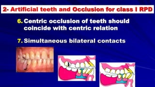 6. Centric occlusion of teeth should
coincide with centric relation
7. Simultaneous bilateral contacts
2- Artificial teeth and Occlusion for class I RPD
 