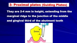 They are 2-4 mm in height, extending from the
marginal ridge to the junction of the middle
and gingival third of the abutment tooth
3- Proximal plates (Guiding Plates)
 