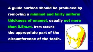A guide surface should be produced by
removing a minimal and fairly uniform
thickness of enamel, usually not more
than 0.5m.m. from around
the appropriate part of the
circumference of the tooth.
 
