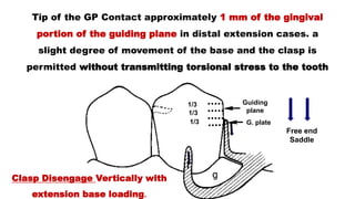 1/3
1/3
1/3
Tip of the GP Contact approximately 1 mm of the gingival
portion of the guiding plane in distal extension cases. a
slight degree of movement of the base and the clasp is
permitted without transmitting torsional stress to the tooth
Clasp Disengage Vertically with
extension base loading.
Free end
Saddle
Guiding
plane
G. plate
 