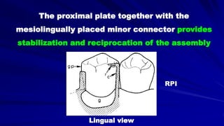 The proximal plate together with the
mesiolingually placed minor connector provides
stabilization and reciprocation of the assembly
RPI
Lingual view
 