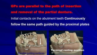 GPs are parallel to the path of insertion
and removal of the partial denture.
Initial contacts on the abutment teeth Continuously
follow the same path guided by the proximal plates
Parallel guiding surfaces
Terminal resting position
 