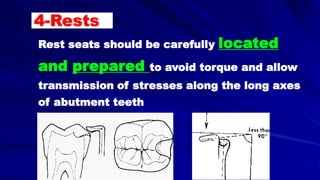 Rest seats should be carefully located
and prepared to avoid torque and allow
transmission of stresses along the long axes
of abutment teeth
4-Rests
 