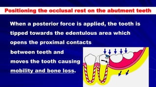 When a posterior force is applied, the tooth is
tipped towards the edentulous area which
opens the proximal contacts
between teeth and
moves the tooth causing
mobility and bone loss.
Positioning the occlusal rest on the abutment teeth
 