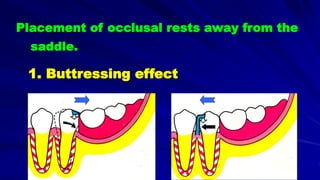 Placement of occlusal rests away from the
saddle.
1. Buttressing effect
 