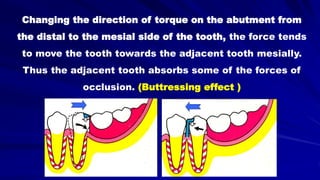 Changing the direction of torque on the abutment from
the distal to the mesial side of the tooth, the force tends
to move the tooth towards the adjacent tooth mesially.
Thus the adjacent tooth absorbs some of the forces of
occlusion. (Buttressing effect )
 