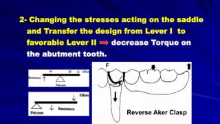 Reverse Aker Clasp
F
2- Changing the stresses acting on the saddle
and Transfer the design from Lever I to
favorable Lever II decrease Torque on
the abutment tooth.
 