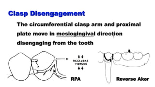 Clasp Disengagement
Reverse Aker
The circumferential clasp arm and proximal
plate move in mesiogingival direction
disengaging from the tooth
RPA
 