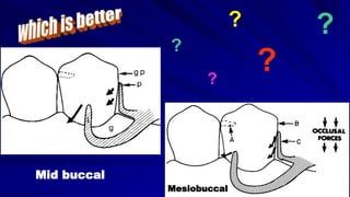 ?
?
? ?
Mid buccal
Mesiobuccal
?
 